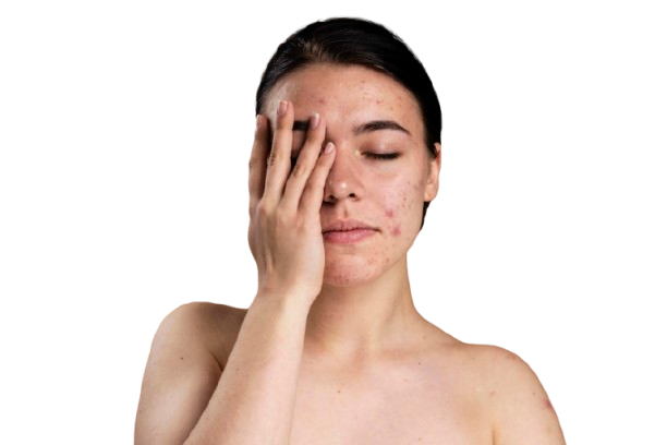 Pimples Treatment