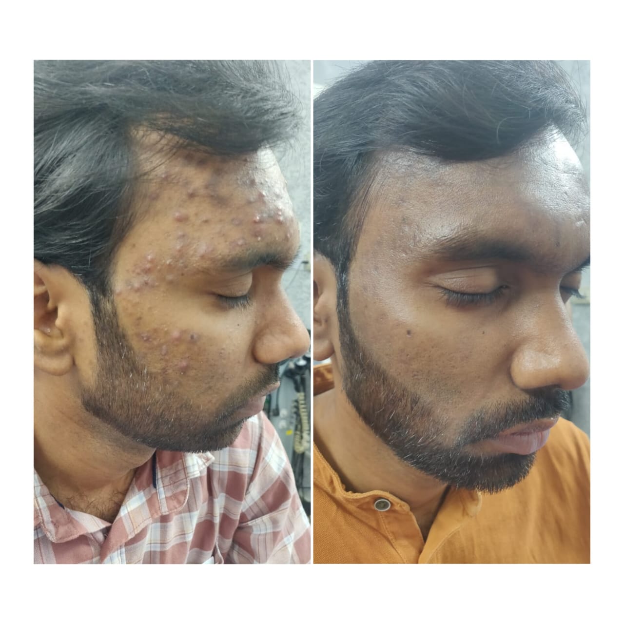 Acne Scar Treatment