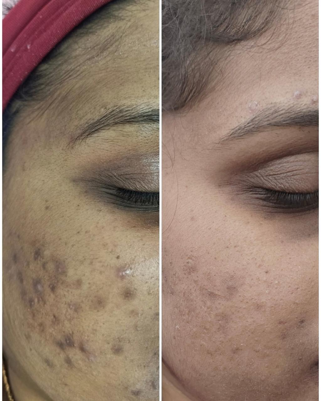 PRP Hair Treatment