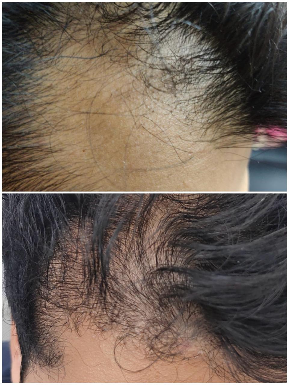 Acne Scar Treatment
