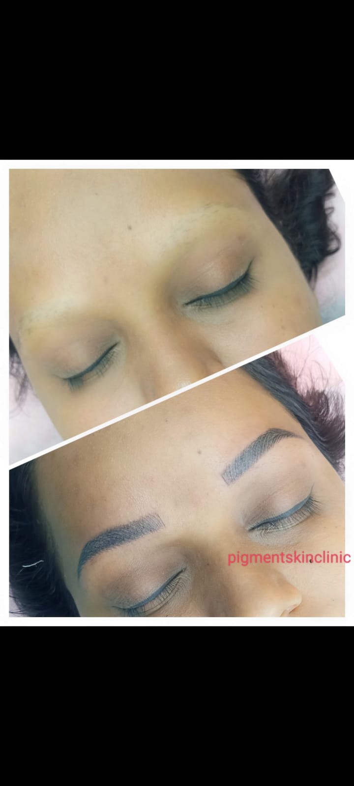 Skin Rejuvenation